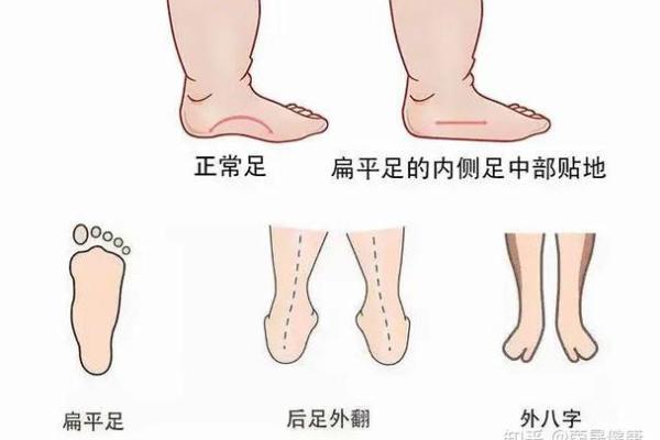 足脊健康知识小课堂（第三期） -  外八字篇